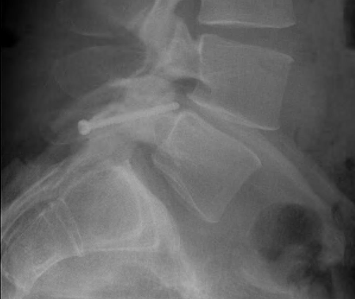 Lytic Pars Defect Unilateral Pars Screw0002